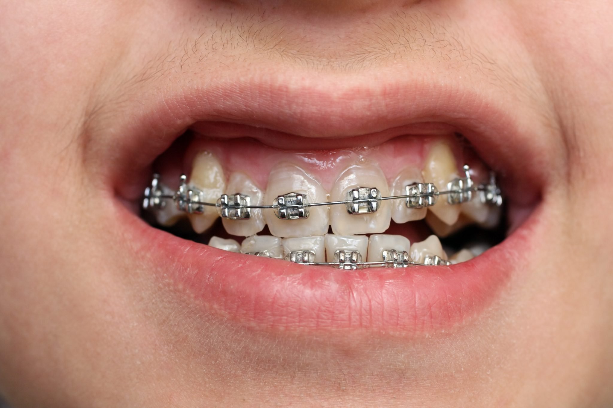 close-up view on children teeth with braces